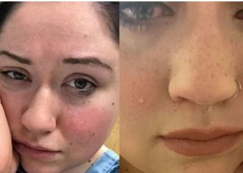 Sëmundja e rrallë, 28-vjeçarja vuan nga “alergjia prej gravitetit”