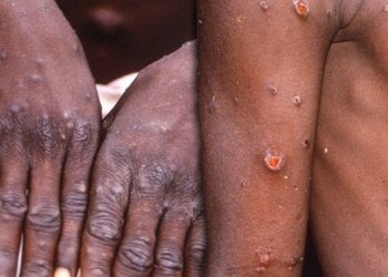 Ministria e Shëndetësisë: Lija e majmunit shtohet në listën e sëmundjeve infektive