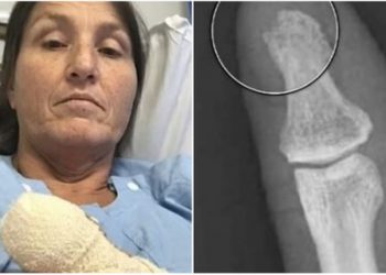 Bëri thonjtë, tani rrezikon të humbasë gishtin