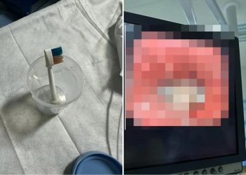 Habiten mjekët, gjejnë furçë dhëmbësh në barkun e 9-vjeçarit