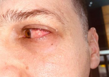 Mjeku tregon simptomat e gripit të syrit: Kujdes, është …