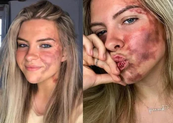 Kujtoi se ishte alergji, modelja tregon se është… –