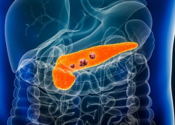 Cilat janë shenjat dhe simptomat e kancerit të pankreasit –