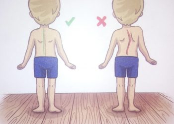 Skolioza tek fëmijët 55% të prekur deri 12 vjeç, –