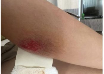 Gruaja shtatzanë sulmohet nga qentë në Prishtinë –