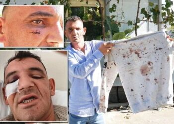 “Më rrahën 20 minuta”, qytetari akuzon policinë e Elbasanit… –