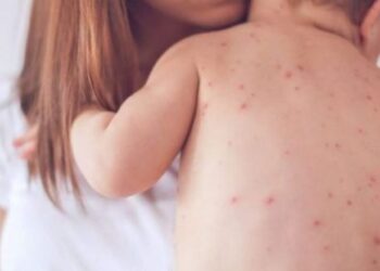 Rritje e rasteve në të gjithë vendin, shpallet epidemia e fruthit –